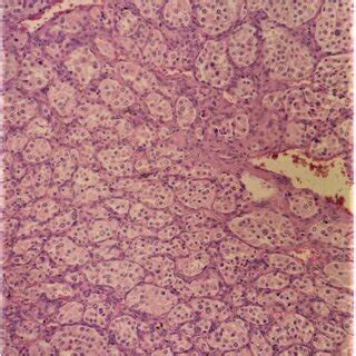 A: IHC analysis of the resected specimens staining positive for ...