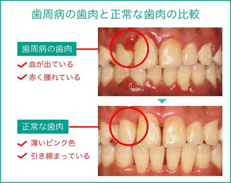 歯周治療／歯周組織再生療法｜西村歯科