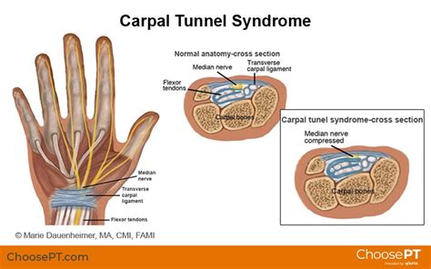 Guide Physical Therapy Guide To Carpal Tunnel Syndrome Choose Pt