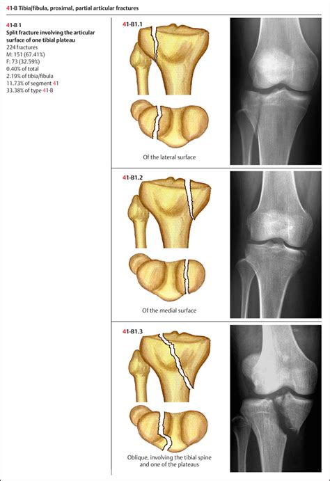 Fractures Of The Tibiafibula Musculoskeletal Key