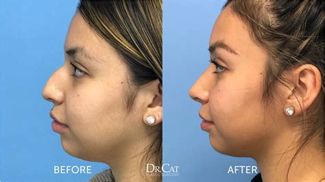 Rhinoplasty Cost And Week By Week Recovery Timeline