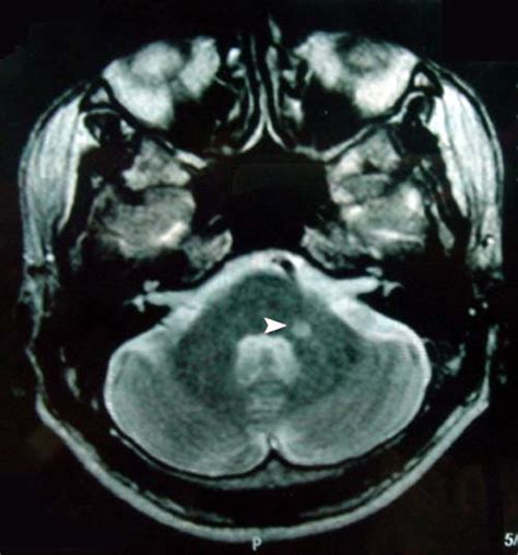 Cerebellar Peduncle Mri Anatomy