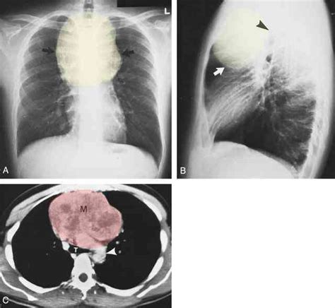 Benign Lung Tumor