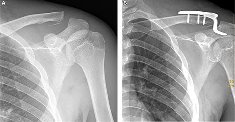 Treatment Of Coracoid Process Fractures Combined With Acromioclavicular Joint Dislocation Using