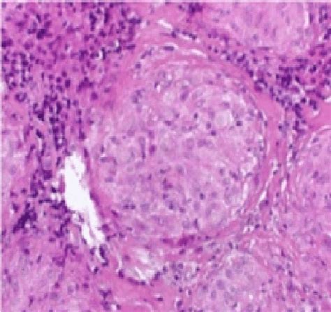 Mediastinal Lymph node biopsy indicate noncaseating epithelioid cell ...