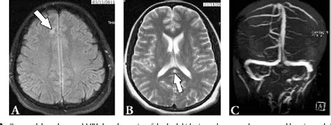 Isolated inferior sagittal sinus thrombosis caused by a rare ...