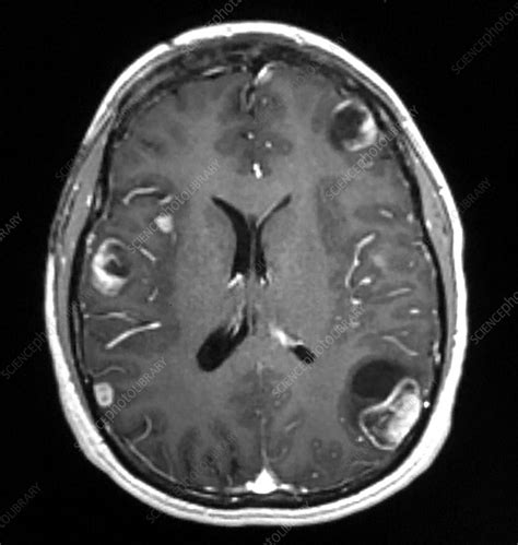 Melanoma Metastatic to Brain, MRI - Stock Image - C039/4204 - Science ...