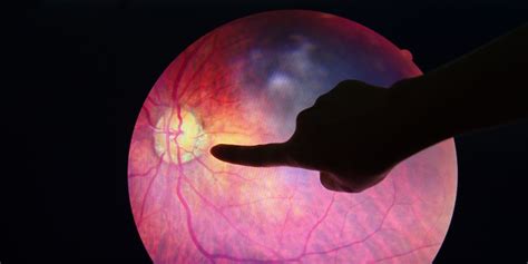 Diabetic Retinopathy Screening And Tests Eye Checks