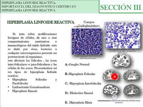 Laminario citológico de hiperplasia linfoide reactiva YouTube