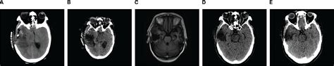 Frontiers Case Report Low Dose Radiation Induced Meningioma With A