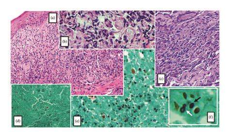 A Hematoxylin And Eosin Stain Original Magnification X Discloses