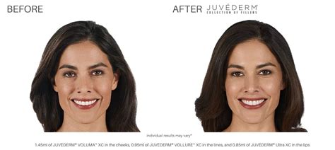 JUVÉDERM BEFORE AND AFTER | REAL PATIENT RESULTS