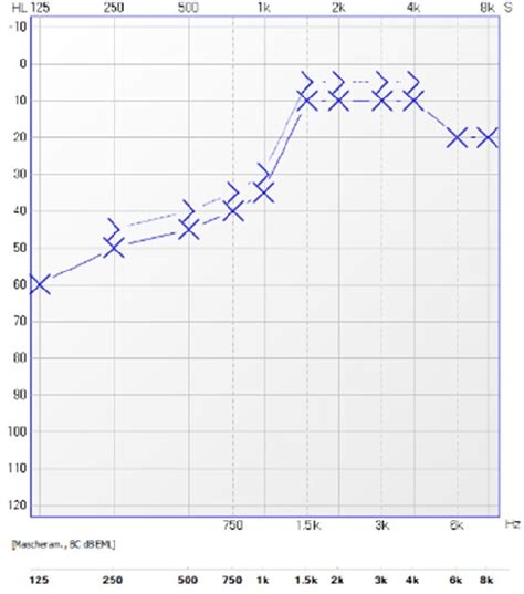 Figure From Tinnitus Aural Fullness And Hearing Loss In A Patient