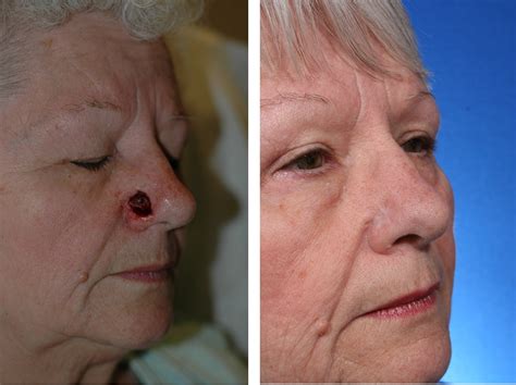 Repairing the nose after skin cancer in just one step