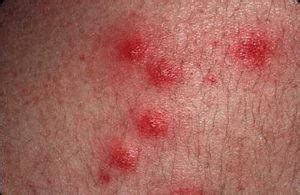 HealthoolPseudomonas “Hot-Tub” Folliculitis Rash Pictures Atlas of ...