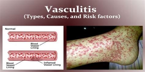 Vasculitis (Types, Causes, and Risk factors) - Assignment Point