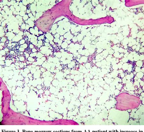 Figure 3 From BONE MARROW ANGIOGENESIS AND MICROVESSEL DENSITY IN