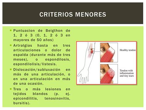 S Ndrome De Hiperlaxitud Articular Ppt