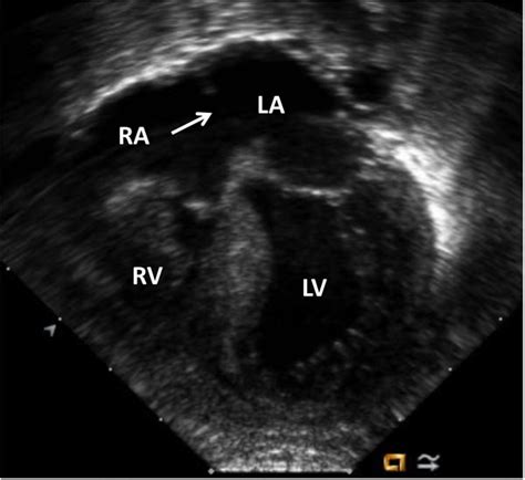 Pulmonary Atresia With Intact Septum