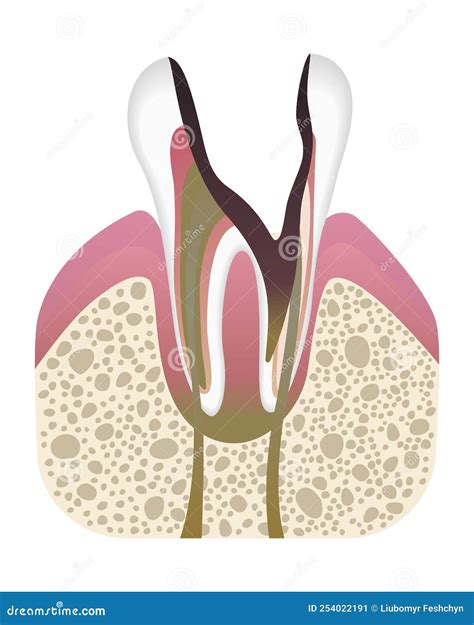 Stage Of Caries Development Tooth Structure In Flat Style Tooth Decay