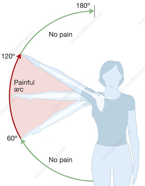 Shoulder Impingement Illustration Stock Image C Science