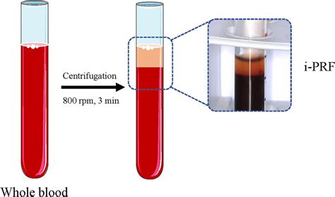 The Preparation Of Injectable Platelet Rich Fibrin After Download