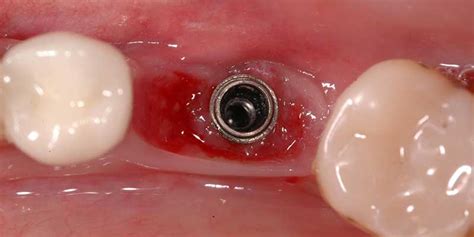 Qué hacemos cuando fracasa un implante dental Nart Clínica Dental