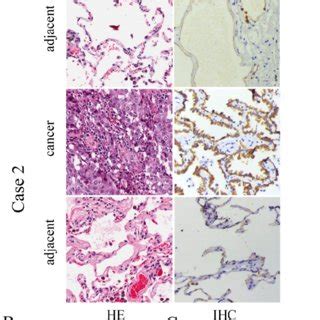 Immunohistochemistry Analysis Of Krt In Ac Patients In A Five Years