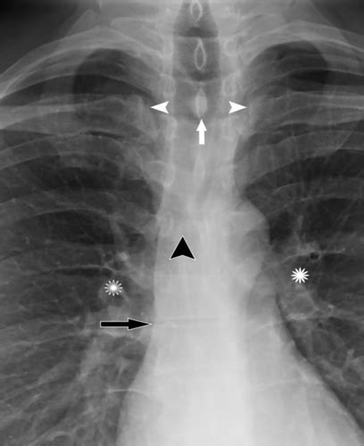 Introduction To Chest Radiography Flashcards Quizlet