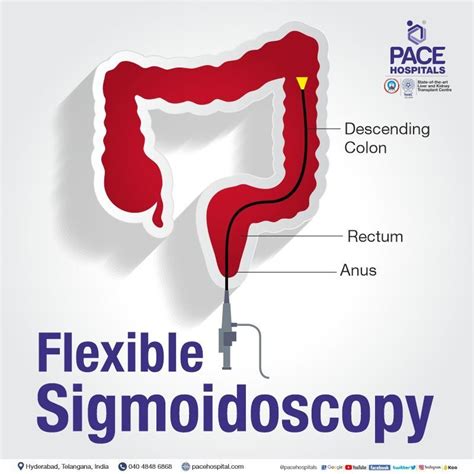 Sigmoidoscopy Test In Hyderabad Indications Purpose Effects And Cost