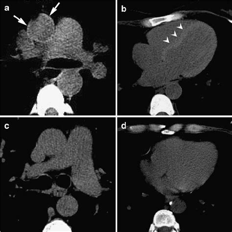 Unenhanced Ct At The Level Of Main Pulmonary Artery A And The