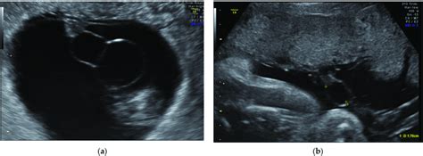 Cyst observed in the 2D ultrasound (a,b). | Download Scientific Diagram