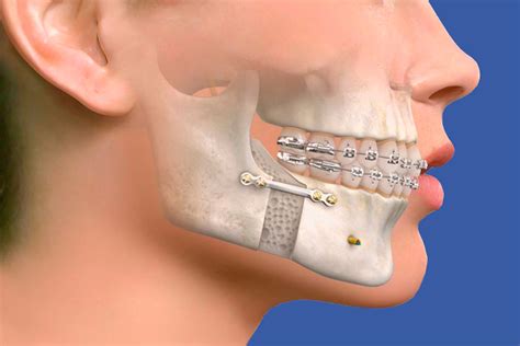 Orthognathic Jaw Surgery Dr Thomas George Arayathinal