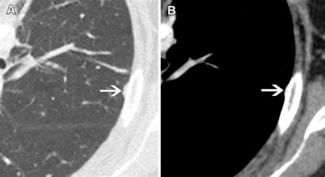 Thymic Imaging Pitfalls And Strategies For Optimized Diagnosis