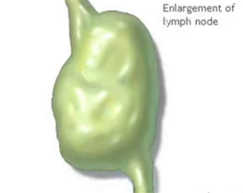 Shotty Lymph Nodes - Symptoms, Causes, Treatment