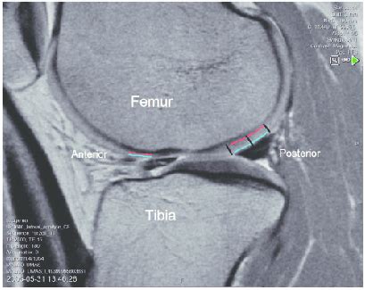 Illustration of the ROIs in the lateral femoral condyle. The femoral ...