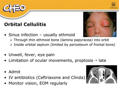 Orbital Cellulitis Ppt