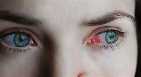 What are the causes and treatment of red eyes? - Redwing News