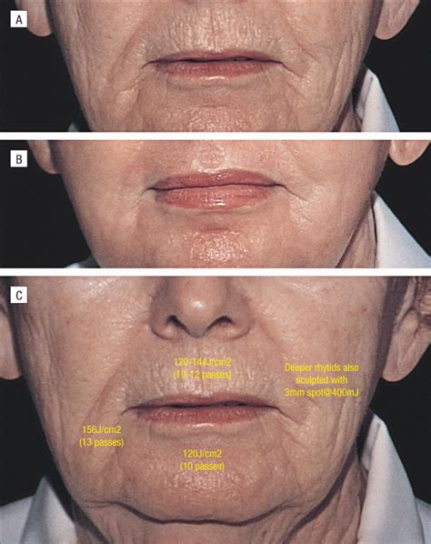 Achieving Superior Resurfacing Results With The Erbiumyag Laser Jama