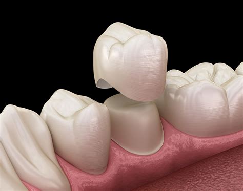 Tipos De Pr Tesis Dentales Para Qu Sirven Y Ventajas