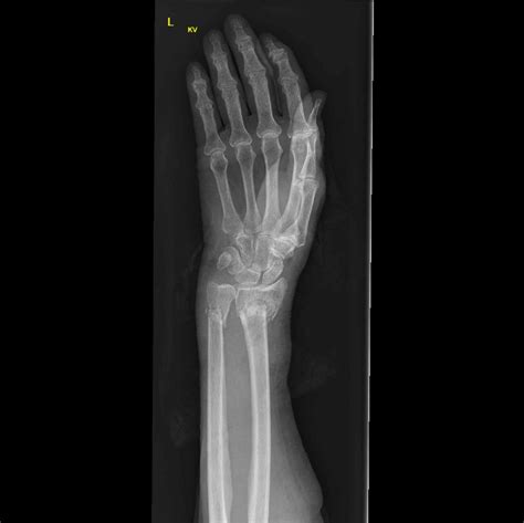 Radiopaedia case Distal radius and ulna fractures id: 70988 study