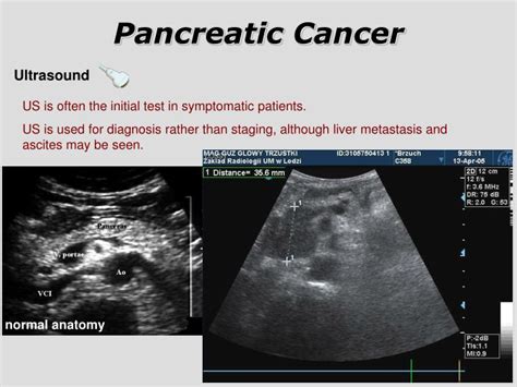 PPT - Pancreatic Cancer PowerPoint Presentation - ID:3295800