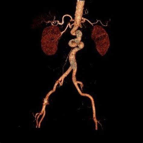 3d Recostruction Of The Abdominal Aorta Demonstrates The Presence Of At Download Scientific