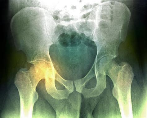 Fractured Pelvis X Ray Photograph By Du Cane Medical Imaging Ltd Pixels