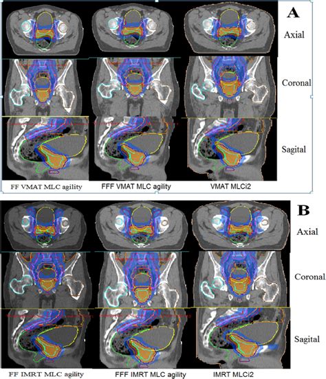 Dose Distribution In Lymph Nodes And Prostate For A Vmat And B Imrt