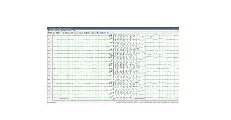 Electroencefalograma Digital EEG Y Mapeo Cerebral ACADEMIA CEREBRITO