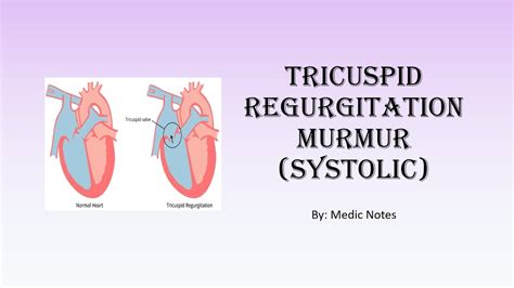 Tricuspid Regurgitation Murmur Description Causes Pathophysiology