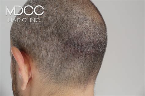 Cicatrices Micropigmentation Cheveux Paris Marseille Toulon Et