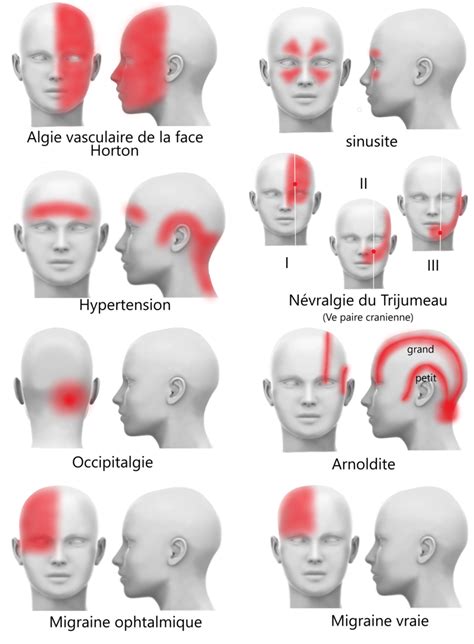 Les Maux de tête Héléna ZEPH