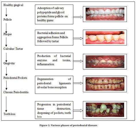 Types Of Periodontal Disease Medical Pictures Info Periodontal